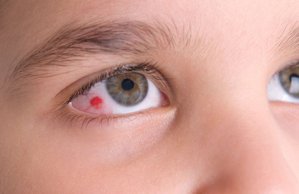 Ader im Auge geplatzt Schlaganfall oder harmloses Warnsignal? ader im auge geplatzt schlaganfall